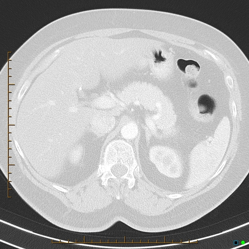 Bronchial diverticula (Radiopaedia 79512-92675 Axial lung window 53).jpg