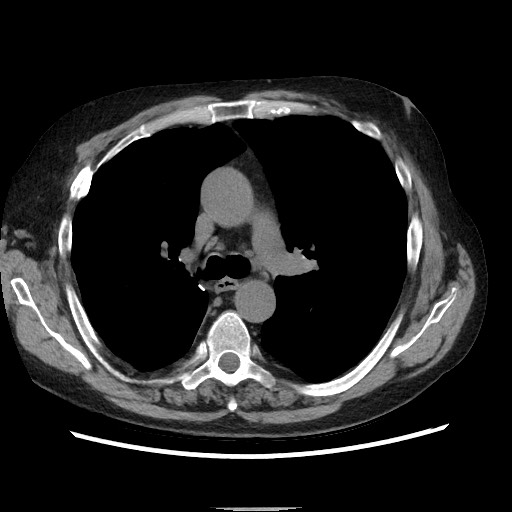 Bronchial stenosis - lung transplant (Radiopaedia 73133-83848 Axial non-contrast 26).jpg