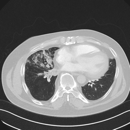 Bronchiectasis (Radiopaedia 39385-41666 Axial lung window 41).png