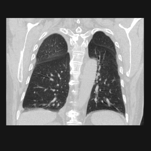 File:Bronchogenic carcinoma with metastatic lymphadenopathy (Radiopaedia 37671-39569 Coronal lung window 34).jpg