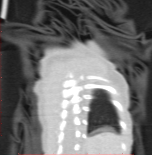 Bronchogenic cyst (Radiopaedia 78599-91409 Coronal lung window 209).jpg
