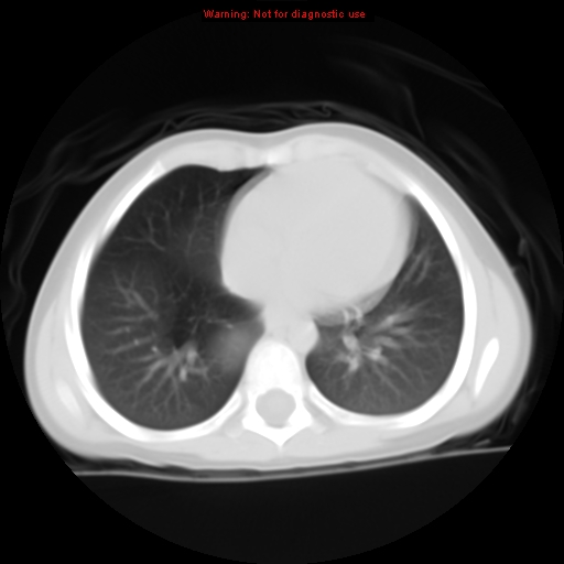 File:Bronchogenic cyst (Radiopaedia 9372-10063 Axial lung window 11).jpg