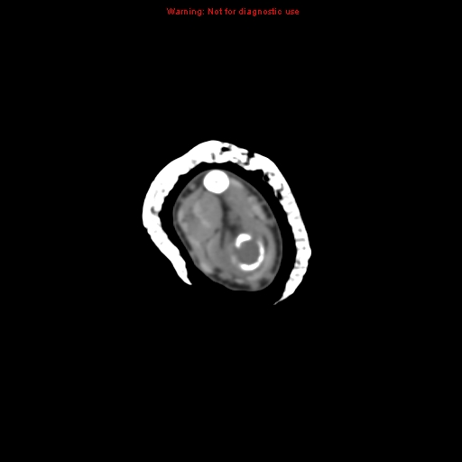 Brown tumor (Radiopaedia 12460-12694 Axial non-contrast 45).jpg