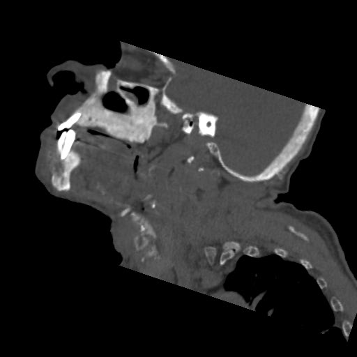 File:Brown tumor with secondary hyperparathyroidism (Radiopaedia 23591-23705 B 8).jpg
