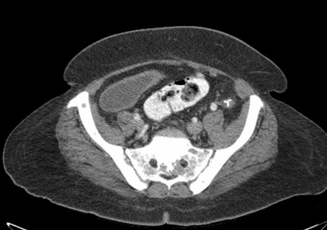 File:Brown tumors compressing the spinal cord (Radiopaedia 68442-77988 E 96).jpg