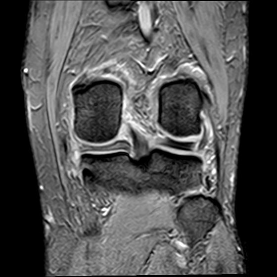 File:Bucket handle tear - medial meniscus (Radiopaedia 29250-29664 B 15).jpg