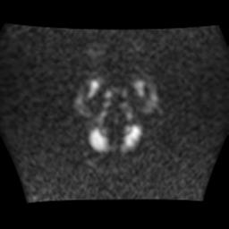 File:Burkitt lymphoma of the orbit- pre and post chemotherapy (Radiopaedia 31214-31930 Axial DWI 1).jpg