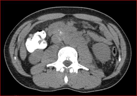 File:Burned-out testicular choriocarcinoma (Radiopaedia 32822-34040 Axial non-contrast 12).jpg