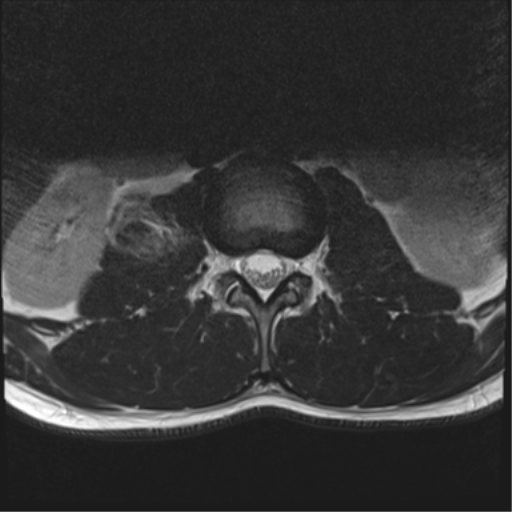 File:Burst fracture - T12 with conus compression (Radiopaedia 56825-63646 Axial T2 3).png