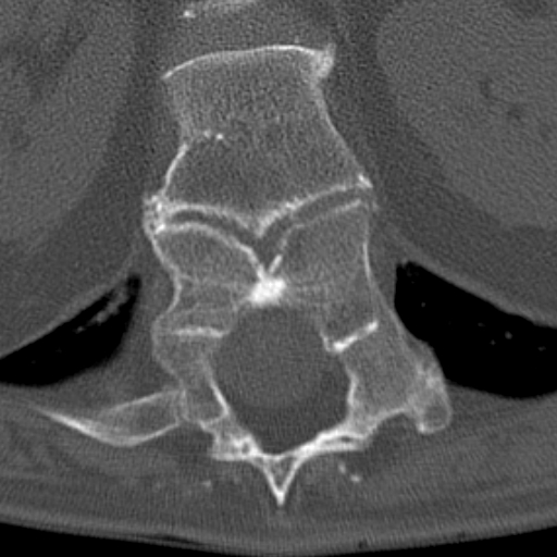 Butterfly vertebrae with kyphoscoliosis (Radiopaedia 14257-14133 Axial bone window 56).jpg