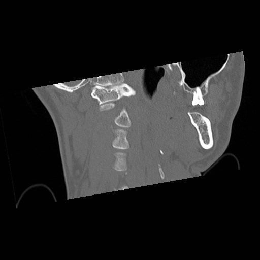 C1-C2 "subluxation" - normal cervical anatomy at maximum head rotation (Radiopaedia 42483-45607 Coronal non-contrast 12).jpg