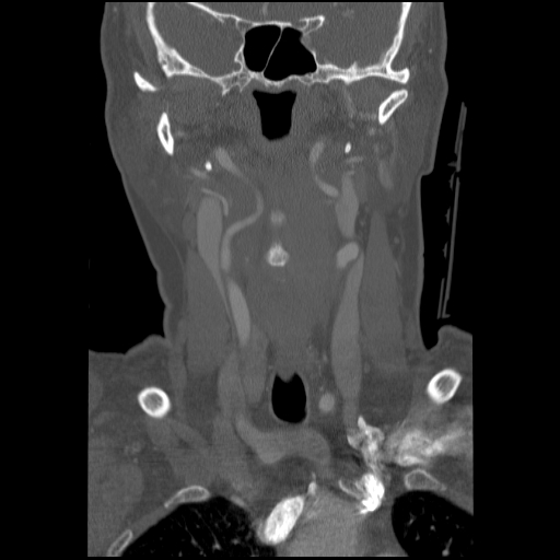 C1 anterior arch (plough) fracture - type 1 (Radiopaedia 76181-87720 Coronal bone window 68).jpg