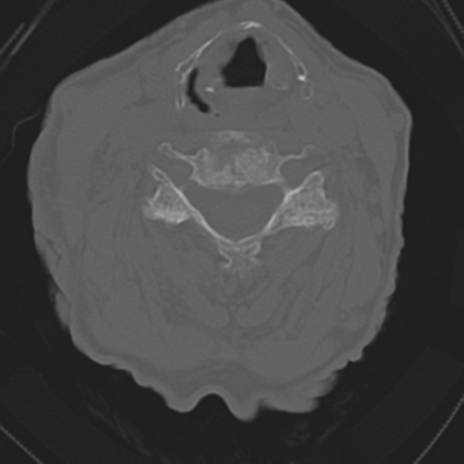 File:C2 fracture with vertebral artery dissection (Radiopaedia 37378-39199 Axial bone window 30).png