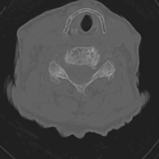 C2 fracture with vertebral artery dissection (Radiopaedia 37378-39199 Axial bone window 33).png