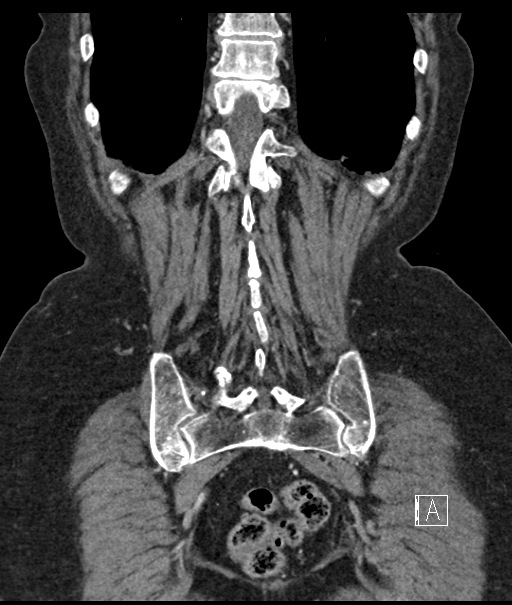 Calcified adrenal glands and Spigelian hernia (Radiopaedia 49741-54988 B 98).jpg
