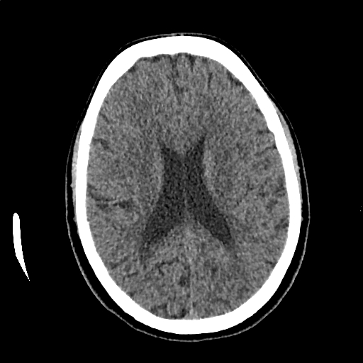 Calcified cerebral hydatid cyst (Radiopaedia 65603-74717 Axial non-contrast 45).jpg