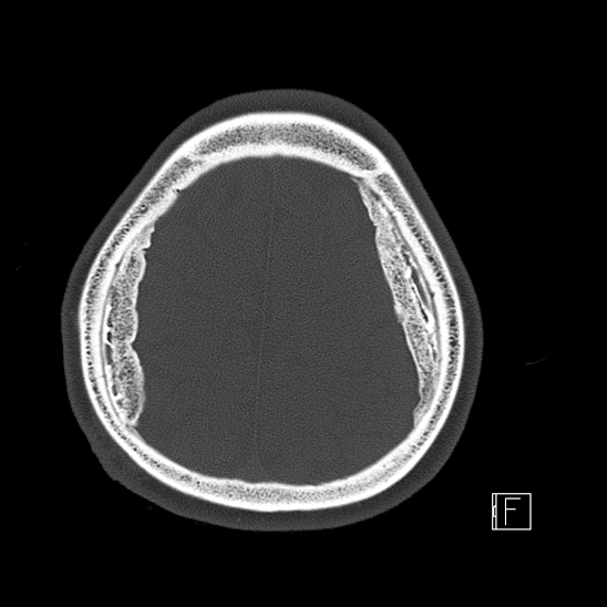 Calcified chronic subdural hematoma (Radiopaedia 77374-89492 Axial bone window 112).jpg