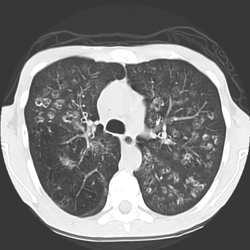 File:Calciphylaxis and metastatic pulmonary calcification (Radiopaedia 10887-11317 Axial lung window 14).jpg