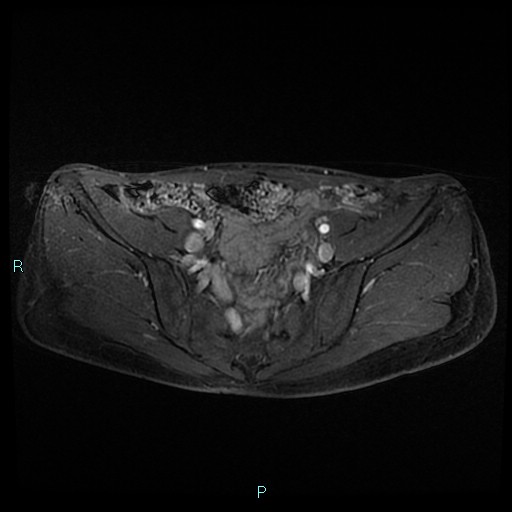 File:Canal of Nuck cyst (Radiopaedia 55074-61448 Axial T1 C+ fat sat 16).jpg