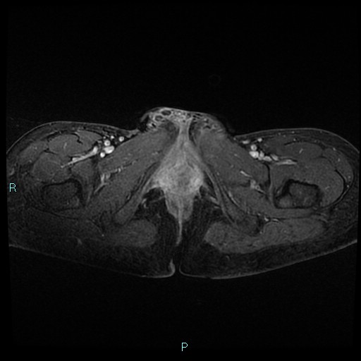 File:Canal of Nuck cyst (Radiopaedia 55074-61448 Axial T1 C+ fat sat 56).jpg