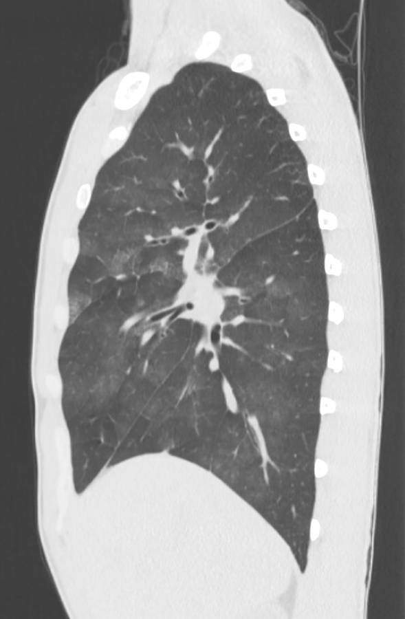 Cannabis-induced diffuse alveolar hemorrhage (Radiopaedia 89834-106946 Sagittal lung window 45).jpg