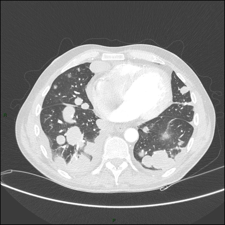 Cannonball metastases (Radiopaedia 82110-96150 Axial lung window 133).jpg