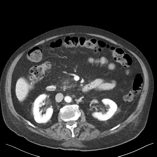 Cannonball metastases from endometrial cancer (Radiopaedia 42003-45031 E 33).png