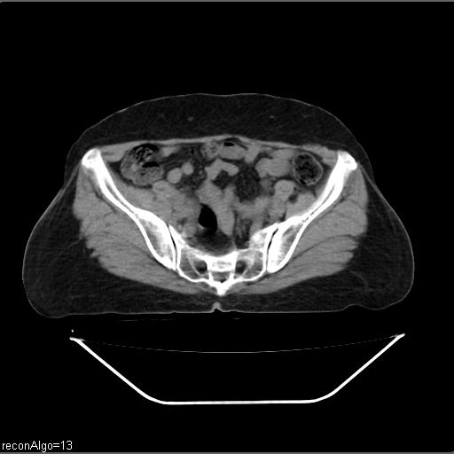 File:Carcinoma cervix- recurrence (Radiopaedia 34702-36137 Axial non-contrast 40).jpg