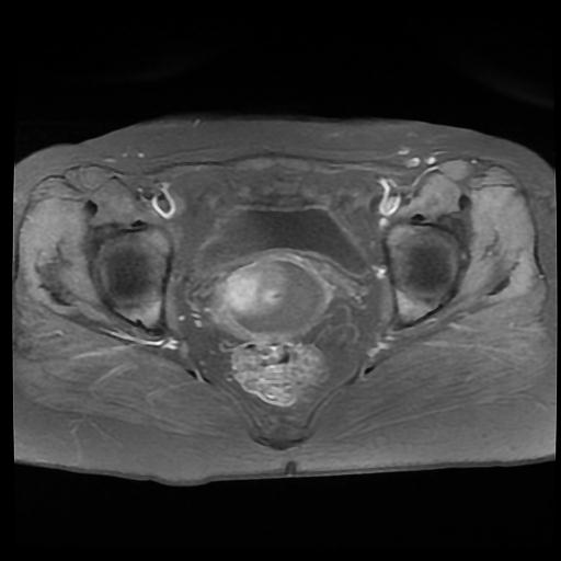 File:Carcinoma of the cervix (Radiopaedia 89018-105858 Axial T1 C+ fat sat 11).jpg