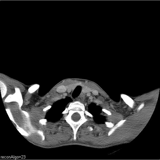 Carcinoma of the maxillary antrum (Radiopaedia 53805-59888 Axial C+ delayed 1).jpg