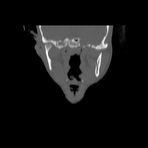 Carcinoma of the maxillary antrum (Radiopaedia 53805-59888 Coronal bone window 77).jpg