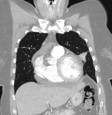 Cardiac sarcoidosis (Radiopaedia 74548-85534 Coronal lung window 18).jpg