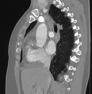 Cardiac sarcoidosis (Radiopaedia 74548-85534 Sagittal lung window 52).jpg