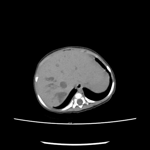 File:Caroli disease with autosomal recessive polycystic kidney disease (ARPKD) (Radiopaedia 89651-106703 E 31).jpg