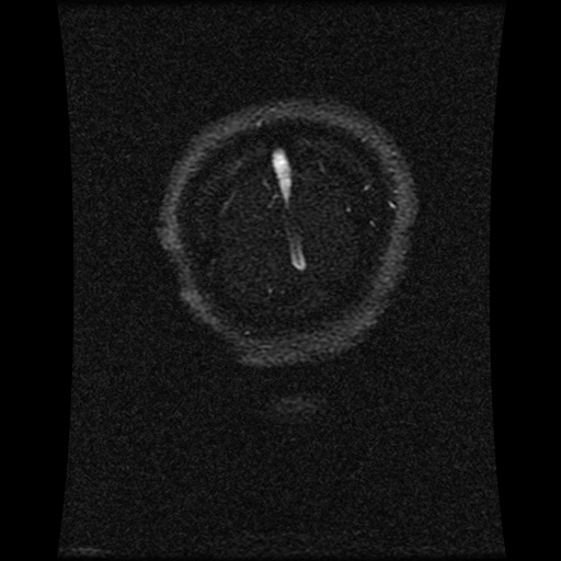 File:Carotid arterial dissection with acute cerebral infarction (Radiopaedia 26636-26784 MRV 34).jpg