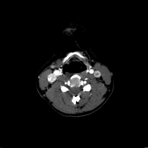 File:Carotid body tumor (Radiopaedia 39845-42300 B 23).jpg