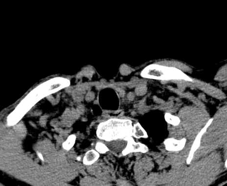 Carotid body tumor (Radiopaedia 61750-69757 Axial non-contrast 108).jpg