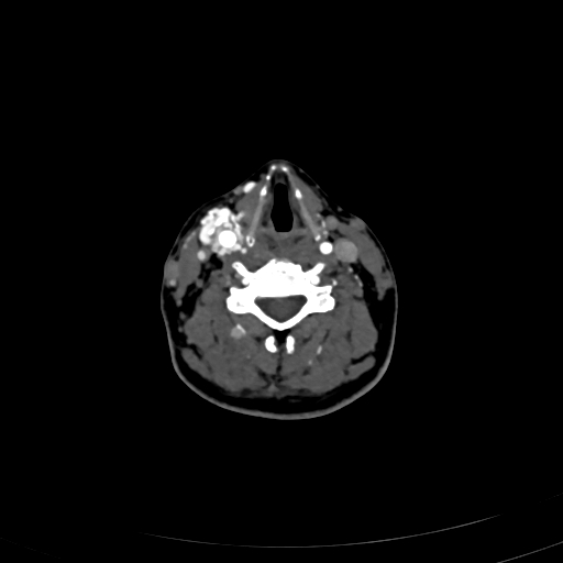 Carotid body tumor (Radiopaedia 83615-98727 A 73).jpg