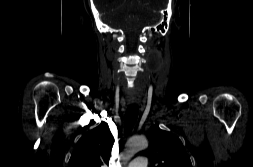 File:Carotid bulb pseudoaneurysm (Radiopaedia 57670-64616 D 44).jpg