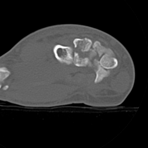 File:Carpo-metacarpal fracture-dislocations with hamatum split fracture (Radiopaedia 18482-18343 Axial bone window 14).jpg