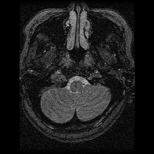 Cavernoma, DVA and right ICA aneurysm (Radiopaedia 33890-35072 E 103).png