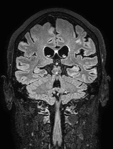 Cavernous hemangioma of the cerebellar falx (Radiopaedia 73025-83724 Coronal FLAIR 218).jpg