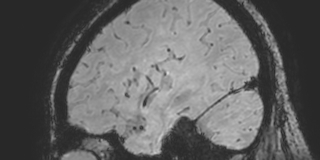 Cavernous hemangioma of the cerebellar falx (Radiopaedia 73025-83724 Sagittal BOLD 161).jpg