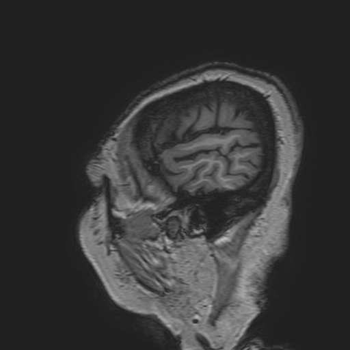 File:Cavernous hemangioma of the cerebellar falx (Radiopaedia 73025-83724 Sagittal T1 22).jpg