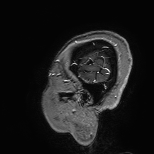 Cavernous hemangioma of the cerebellar falx (Radiopaedia 73025-83724 Sagittal T1 C+ 197).jpg