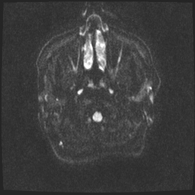File:Cavernous sinus meningioma (Radiopaedia 63682-72367 DWI 42).jpg