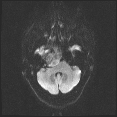 Cavernous sinus meningioma (Radiopaedia 63682-72367 DWI 46).jpg