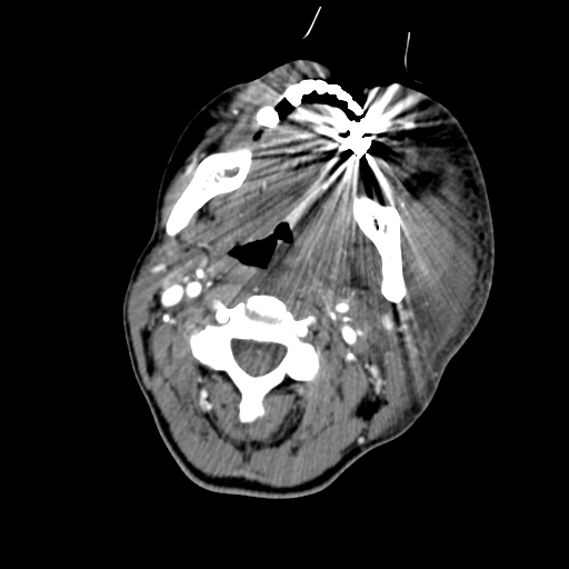 File:Cavernous sinus thrombosis (Radiopaedia 10619-11078 A 15).jpg