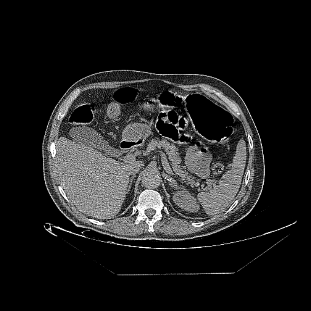 Cavitating bronchogenic carcinoma (Radiopaedia 44489-48162 Axial non-contrast 90).jpg