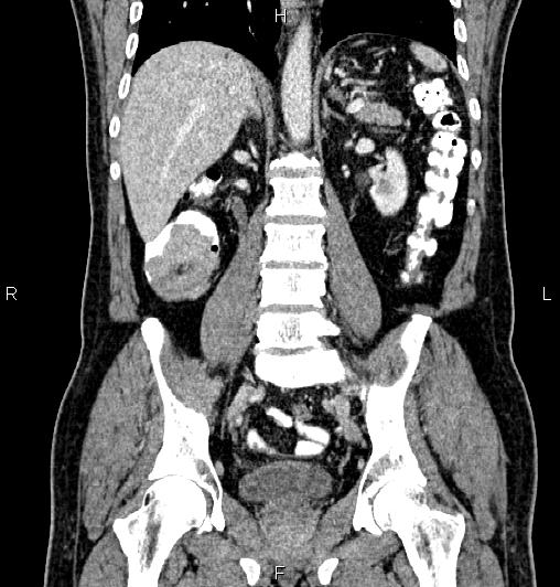 Cecal adenocarcinoma (Radiopaedia 85324-100916 D 40).jpg